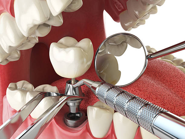 Best Emergency Dental Care for Abscessed Tooth in Venice Gardens, FL
